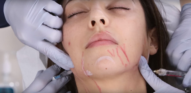 placing dermal filler to give straight jawline