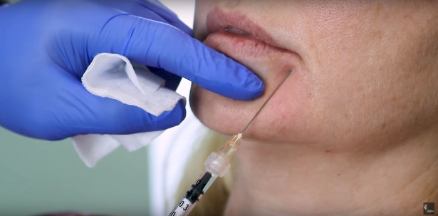 placing dermal fillers in corners of mouth