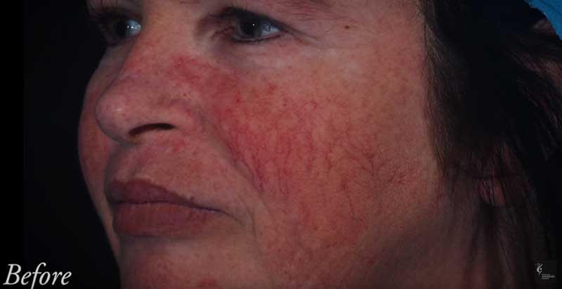 capillaries and facial redness before treatment