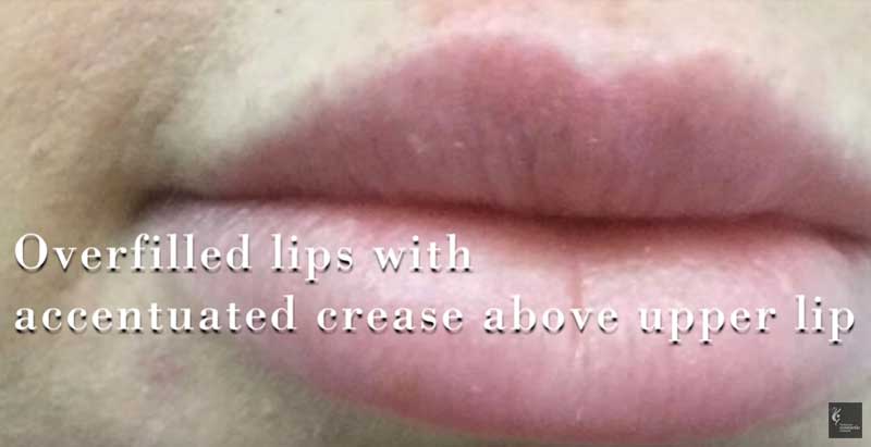 fill the crease in the upper lip