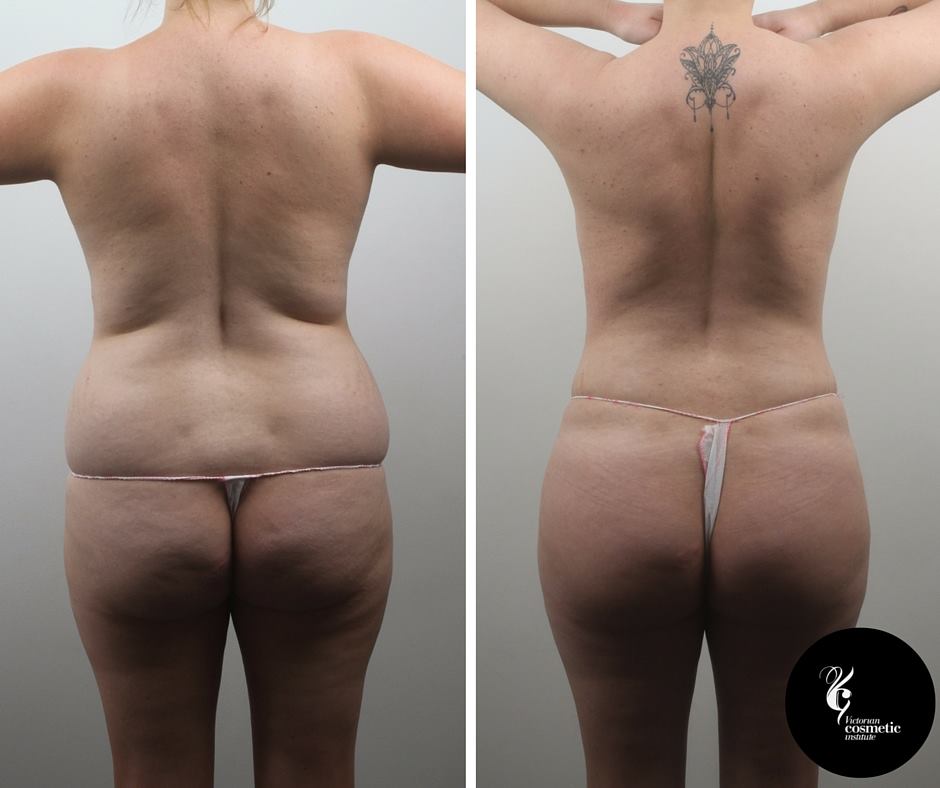 liposuction melbourne full body liposuction before and after
