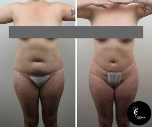 liposuction before and after