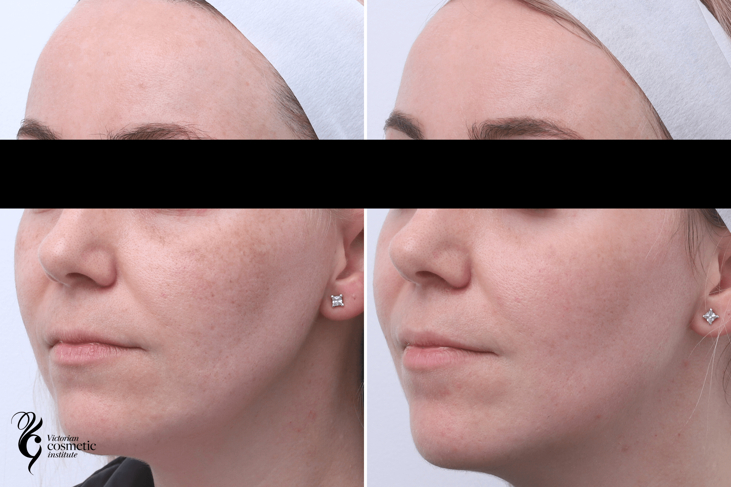 melasma treatment