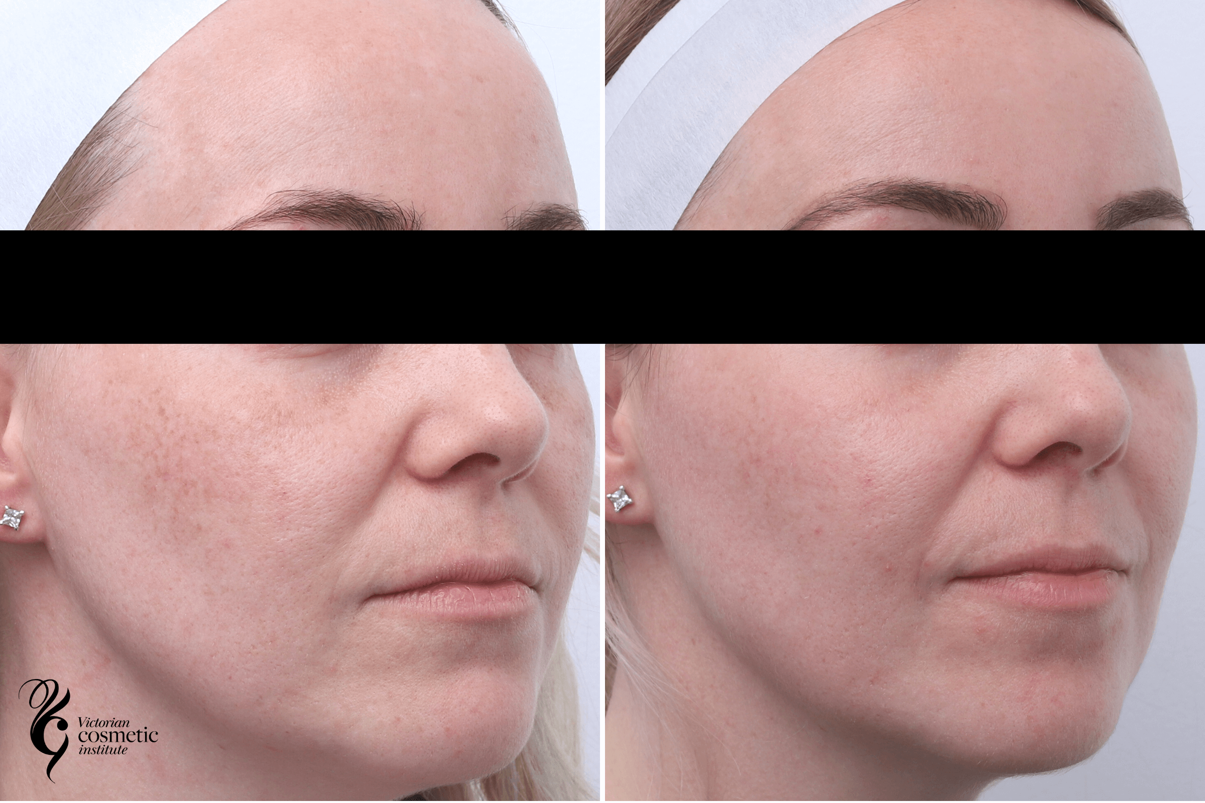 melasma treatment before and after