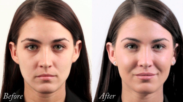 cheek filler before and after