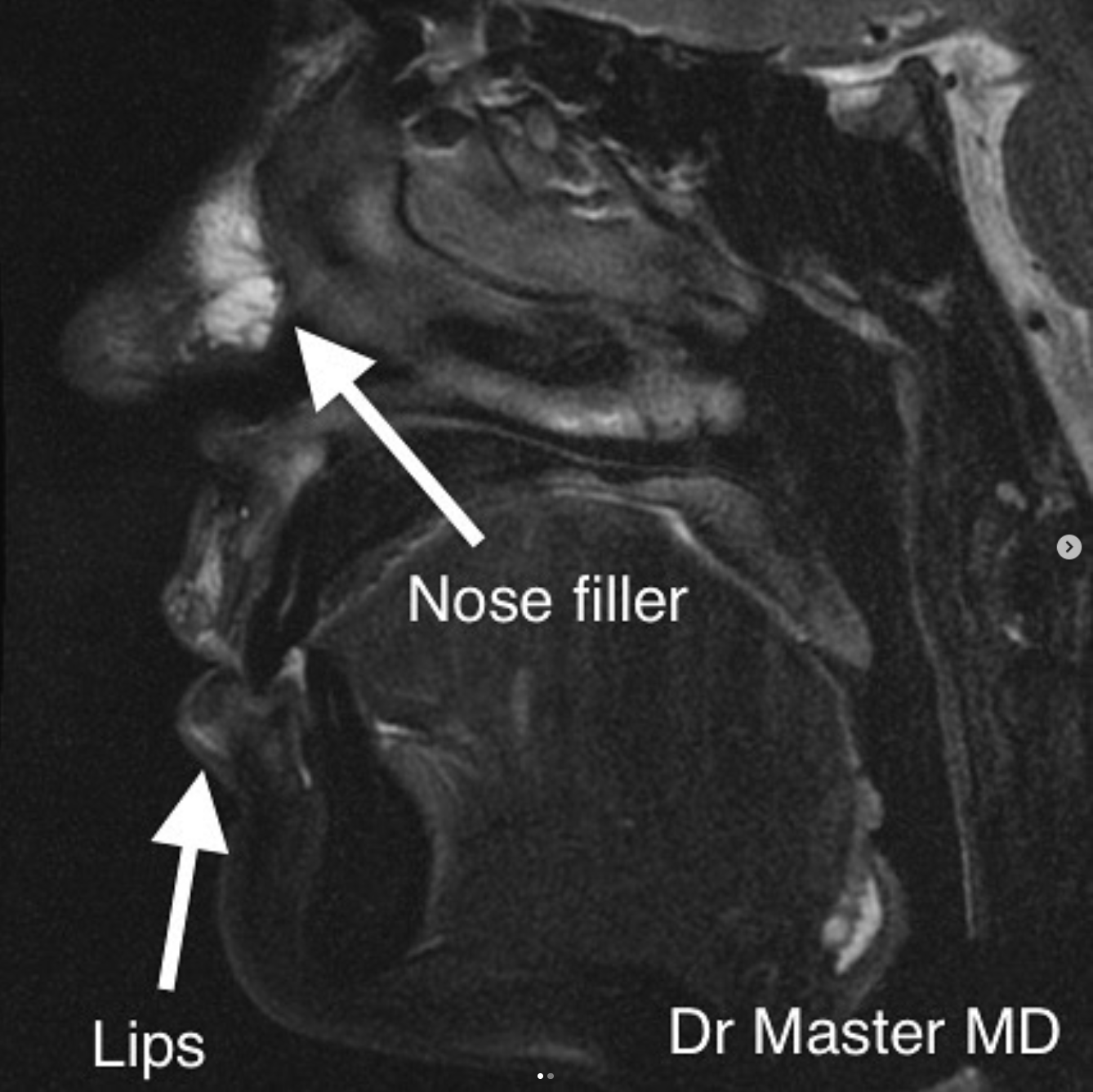 Nose filler on MRI. Credit: Dr. Mobin Master
