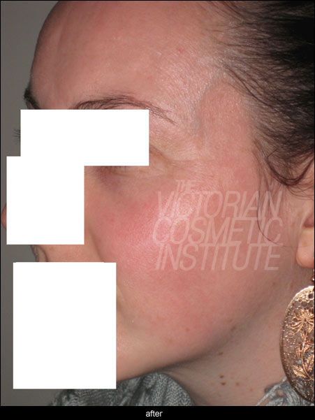 medlite laser freckle removal after