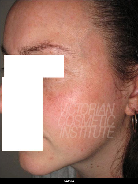 medlite laser freckle removal before