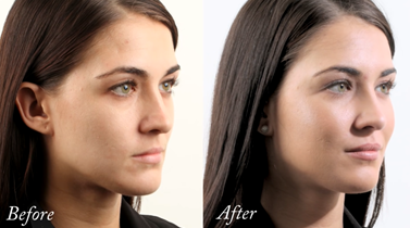 cheek filler before and after