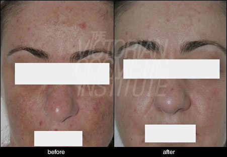 melasma before and after
