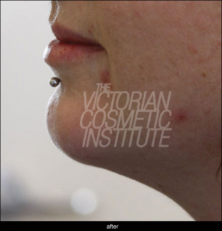 non surgical chin enhancement after