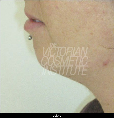 non surgical chin enhancement