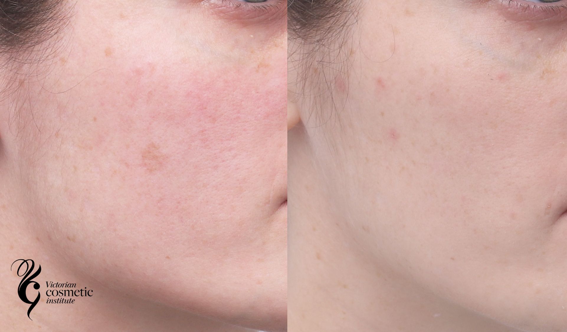 ruby laser sunspot removal melbourne