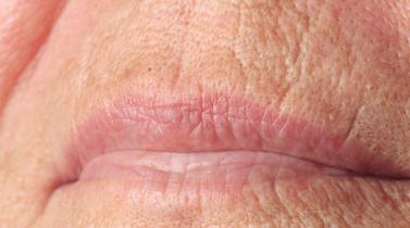 upper lip wrinkles