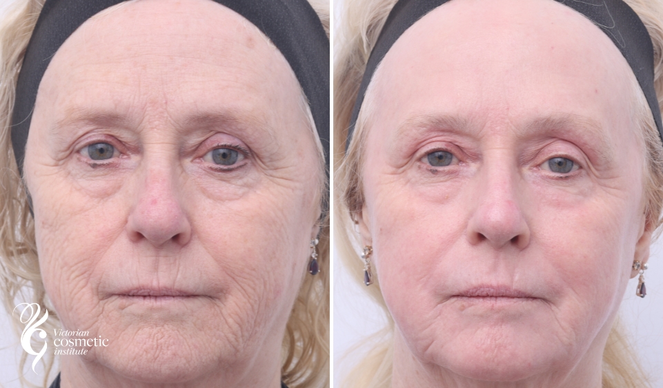 co2 laser before and after face photo