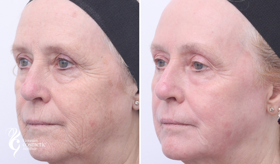 co2 laser skin resurfacing before and after photo of left side face