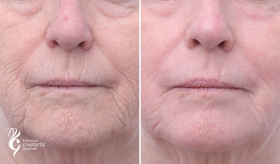 co2 laser skin resurfacing before and after photo of lower face around mouth and chin