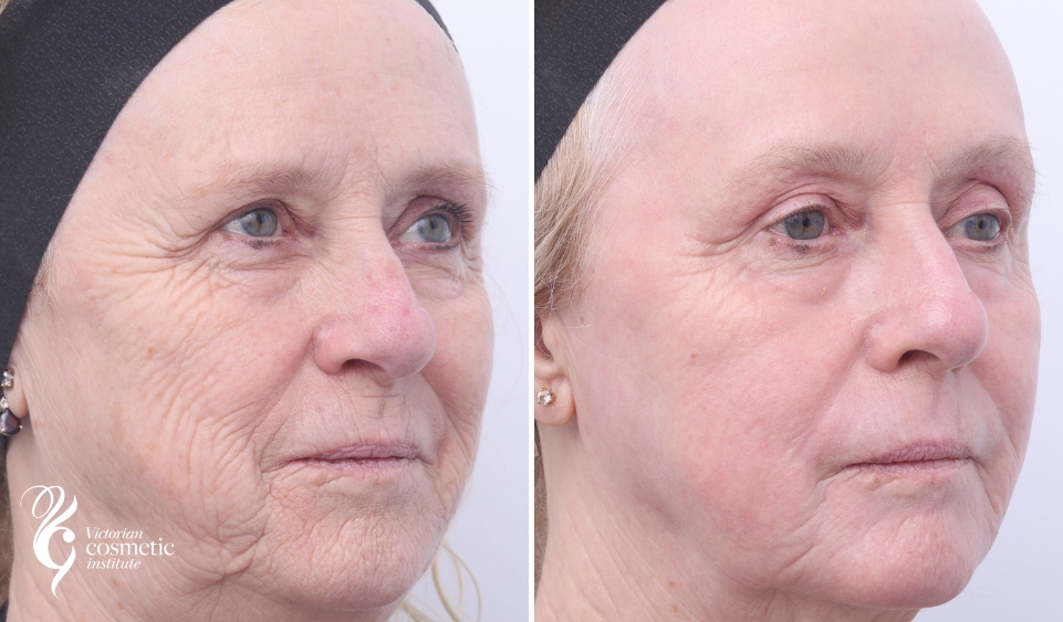 co2 laser skin resurfacing before and after photo right side face