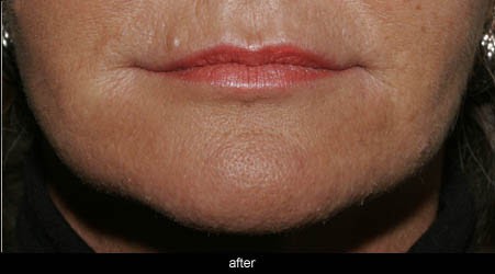 non surgical jowl reduction after