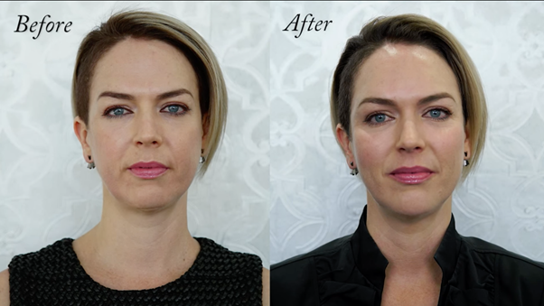 chin filler before and after