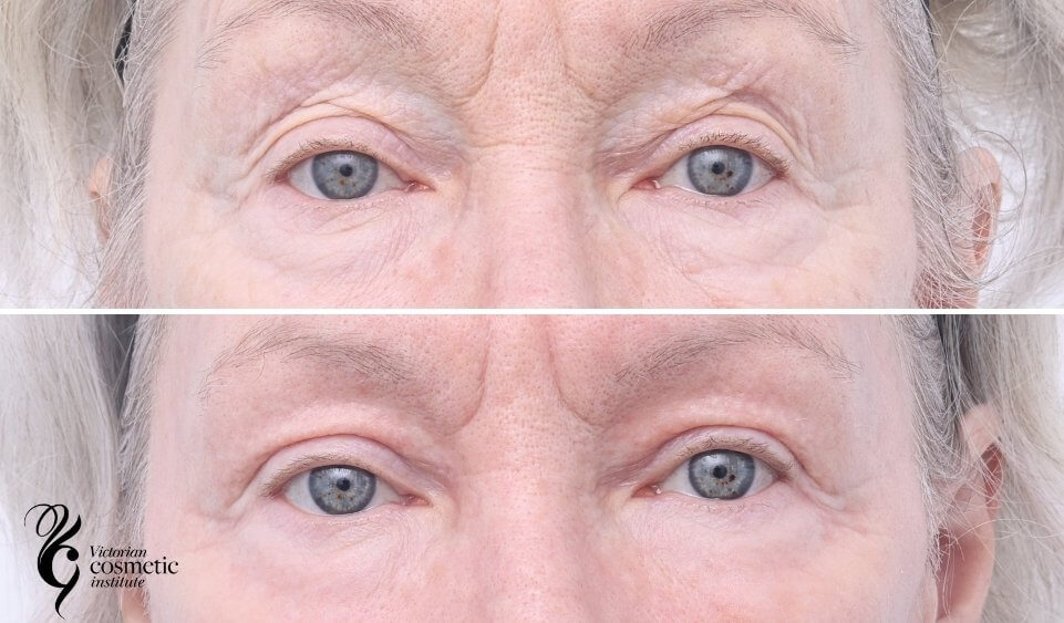 co2 upper eyes before and after
