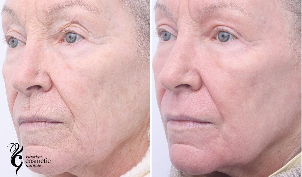 co2 laser resurfacing before and after left side face