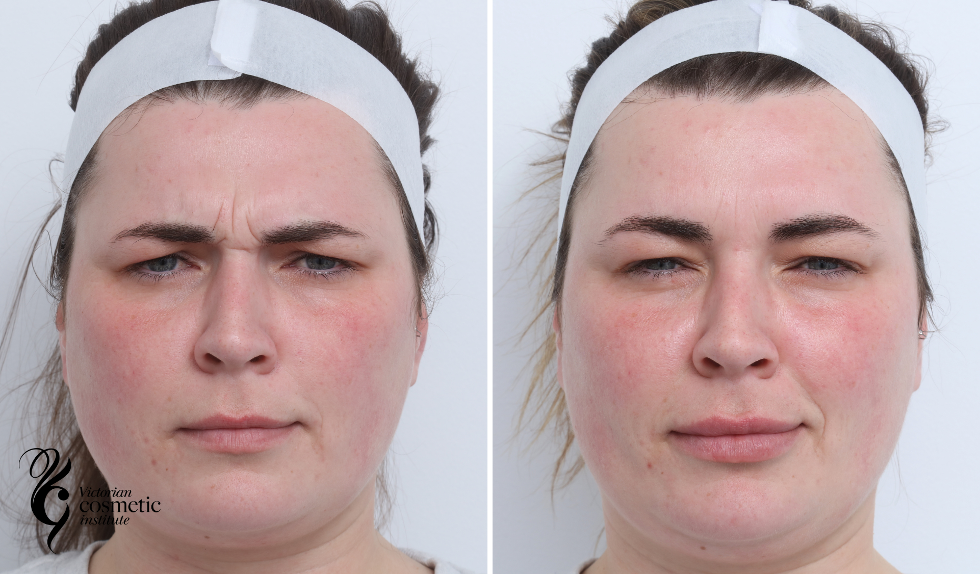 frown before and after anti wrinkle injections