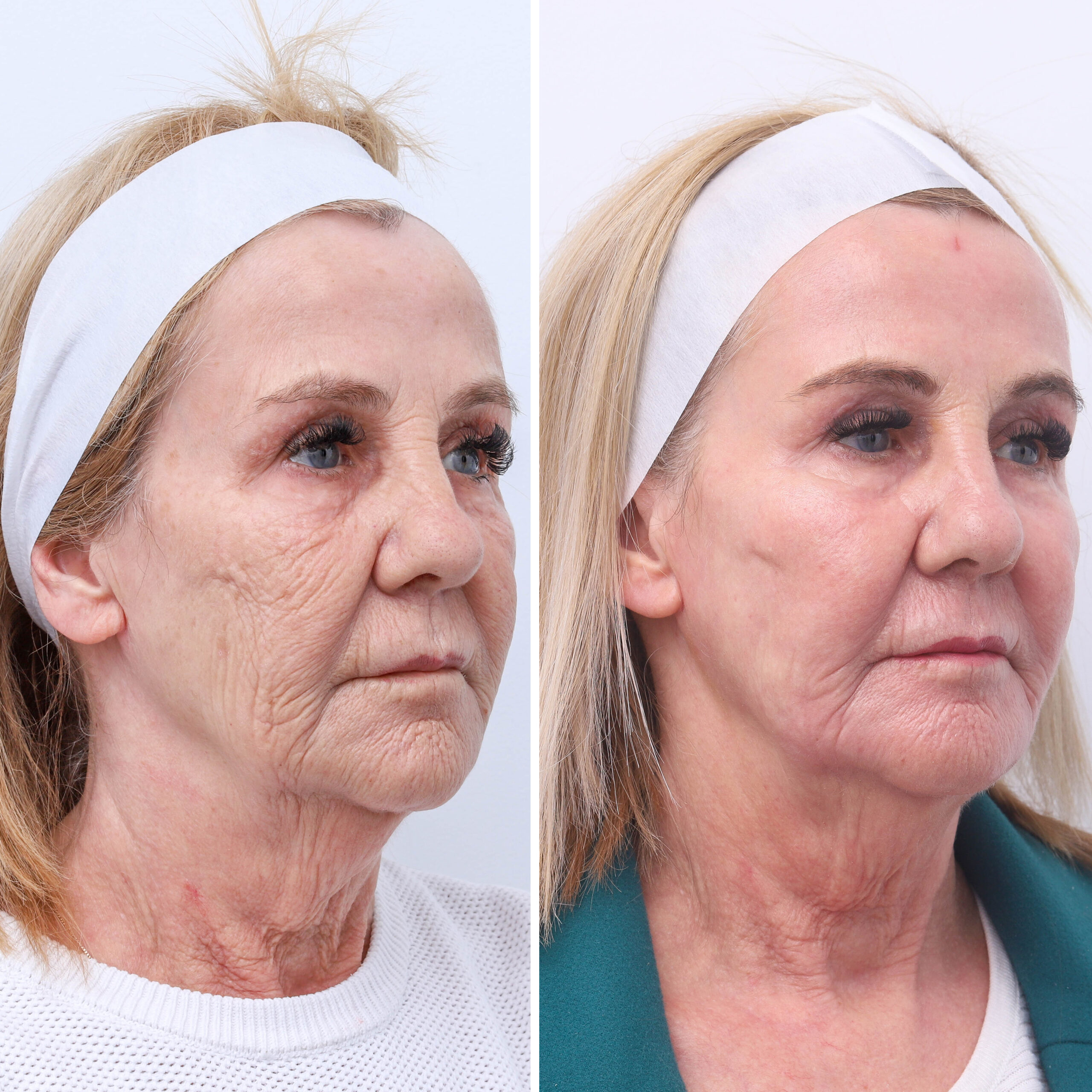 before and 3 months after co2 laser resurfacing 