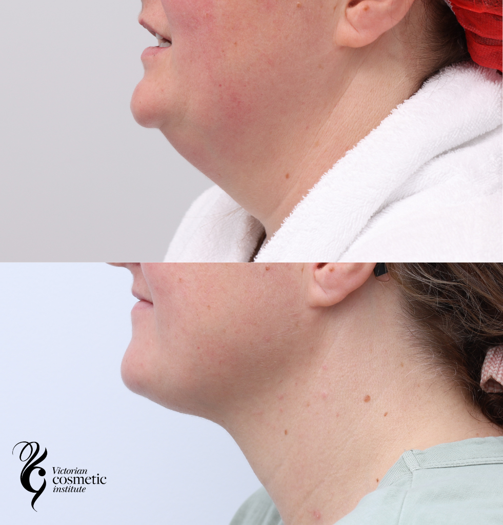 Neck liposuction before and after