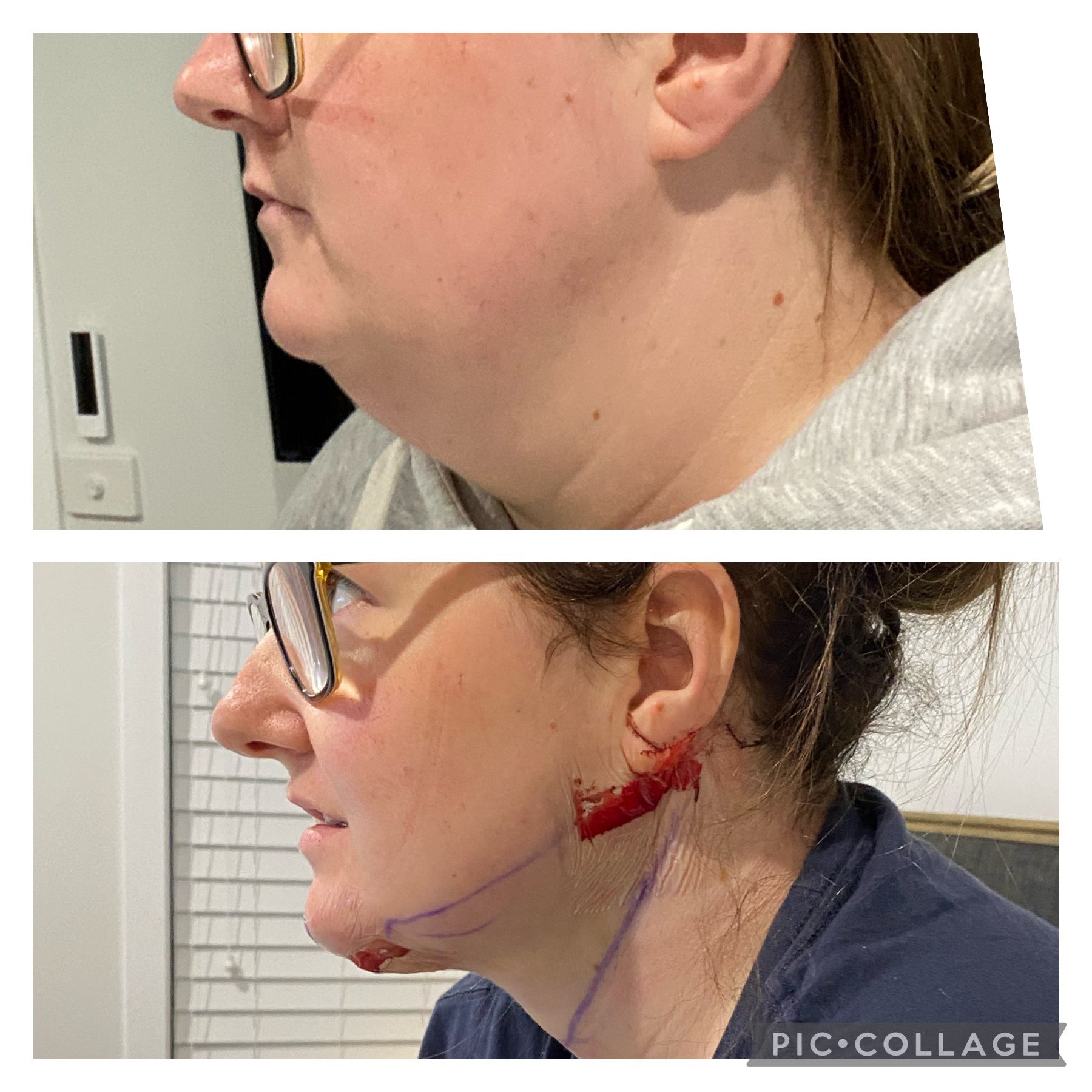 neck liposuction melbourne before and after