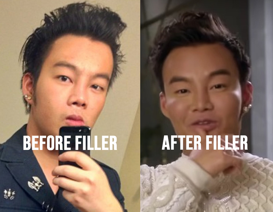 kane lim before and after filler