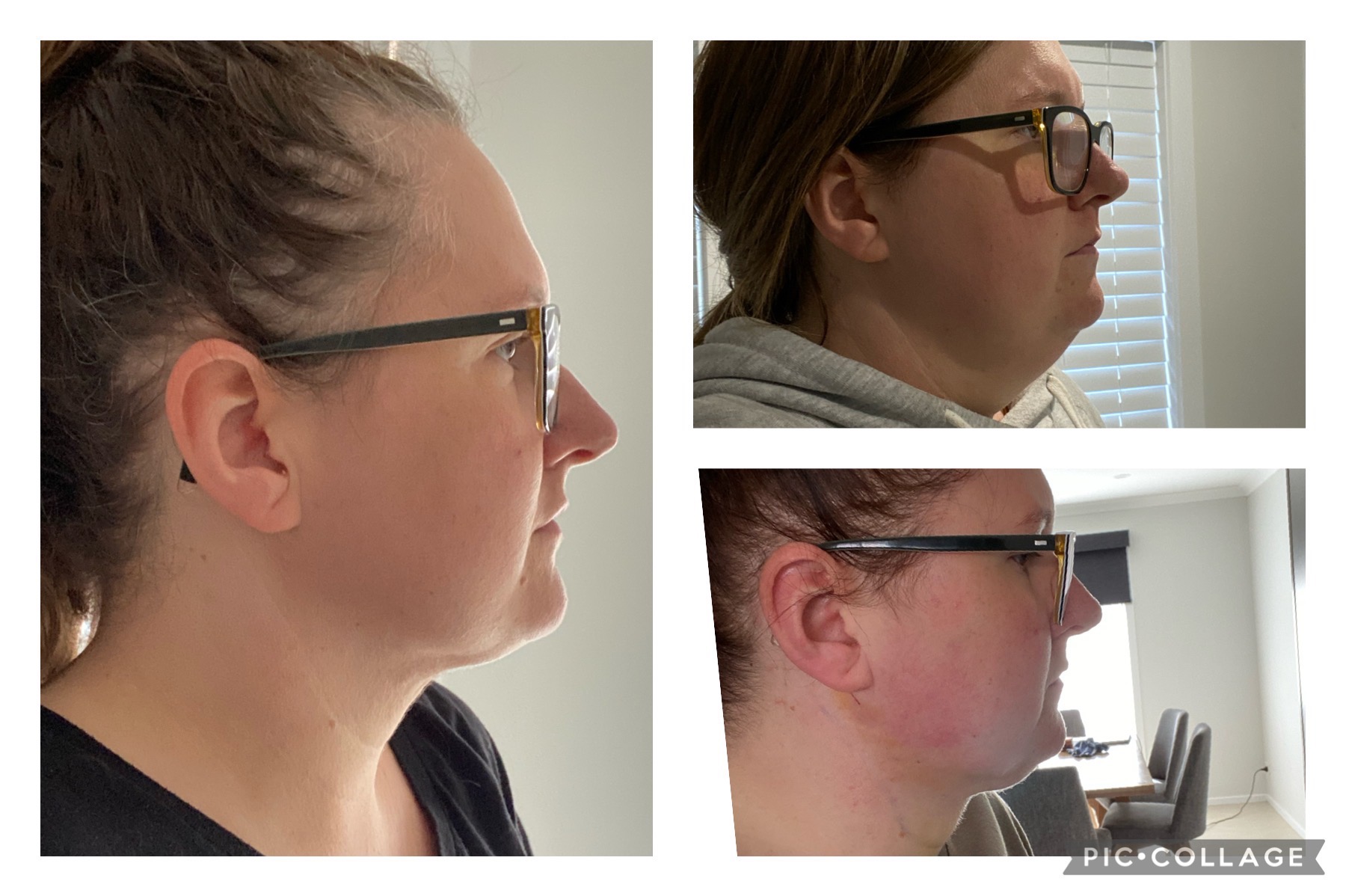neck liposuction melbourne 1 month post op before and after