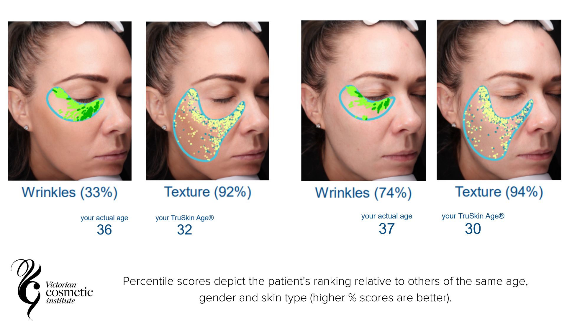 bioremodelling before and after