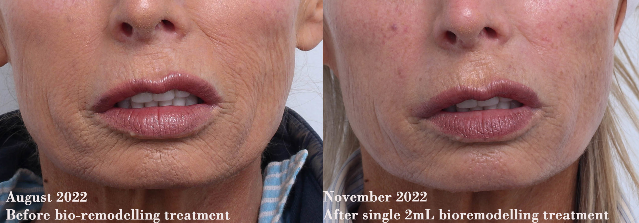 Profhilo treatment before and after