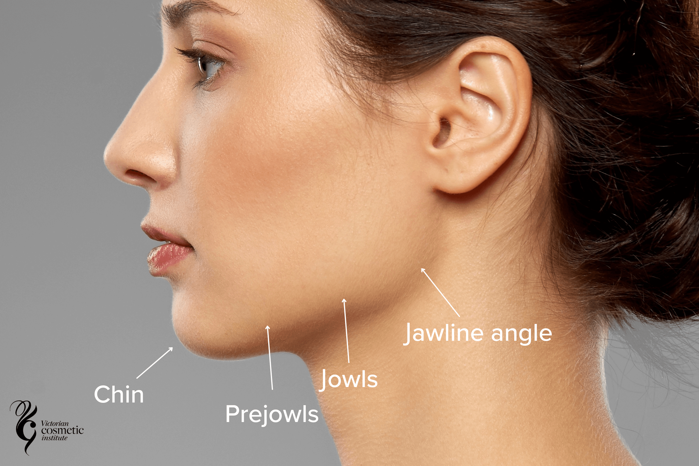 jawline filler anatomy