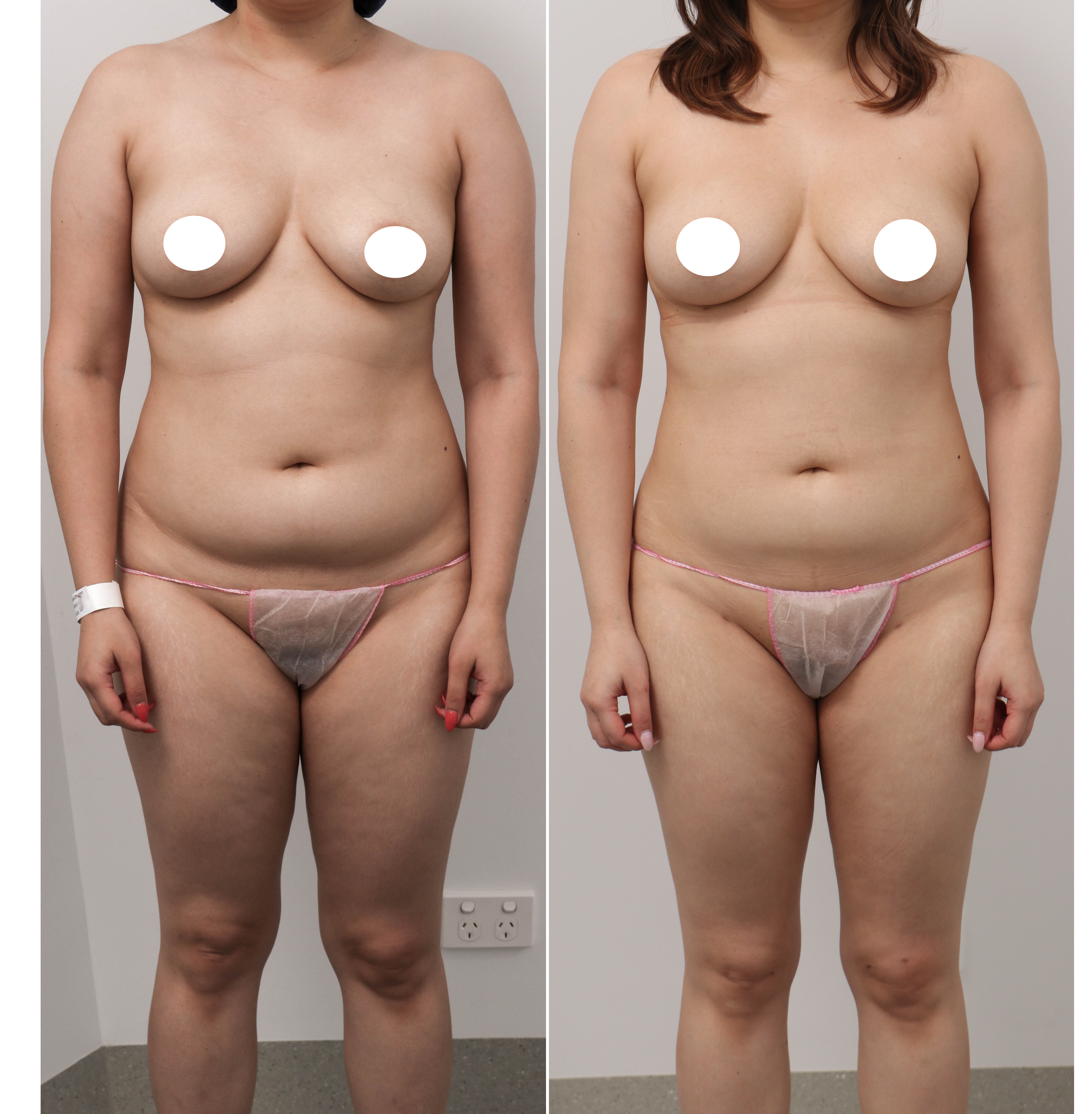 liposuction before and after