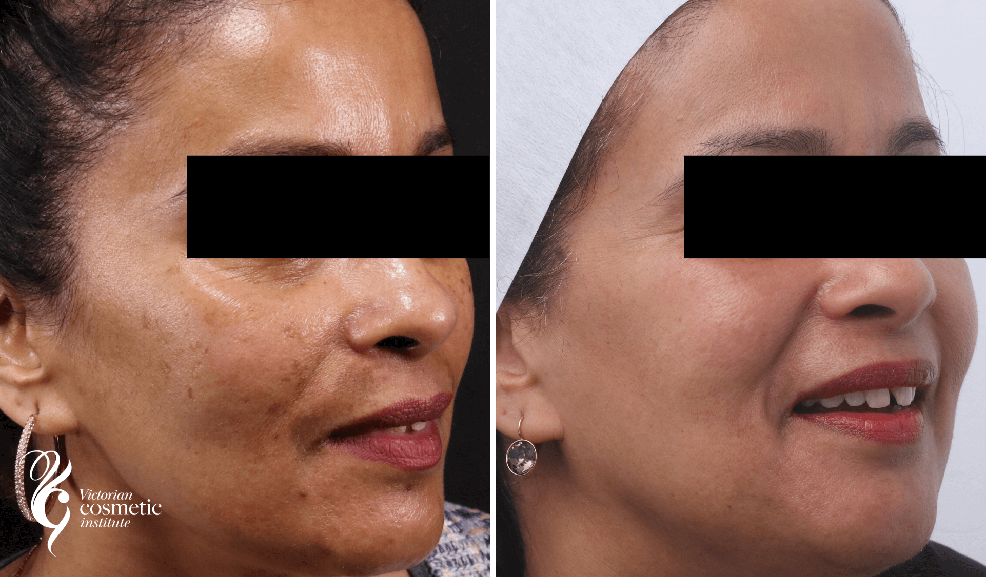 Melasma treatment before and after