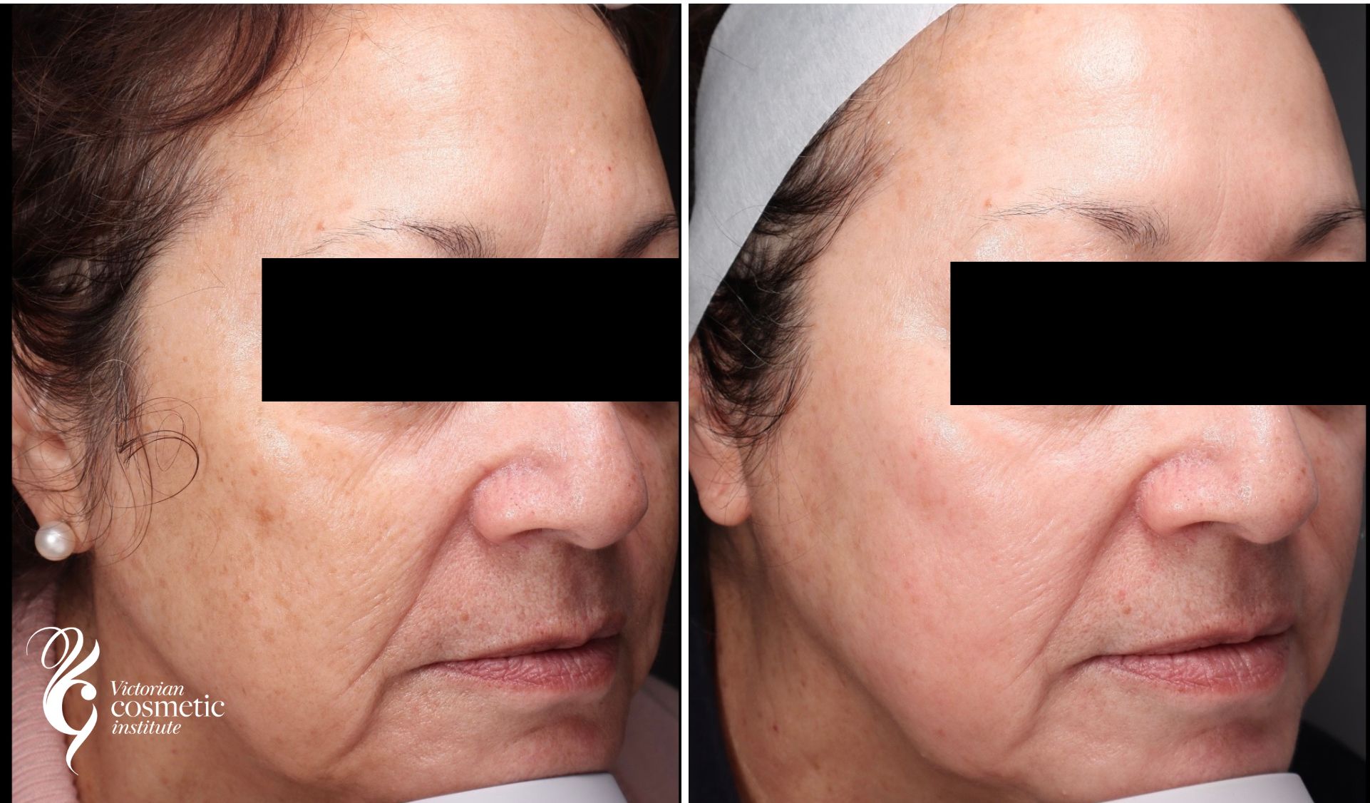 Cosmelan peel before and after photo