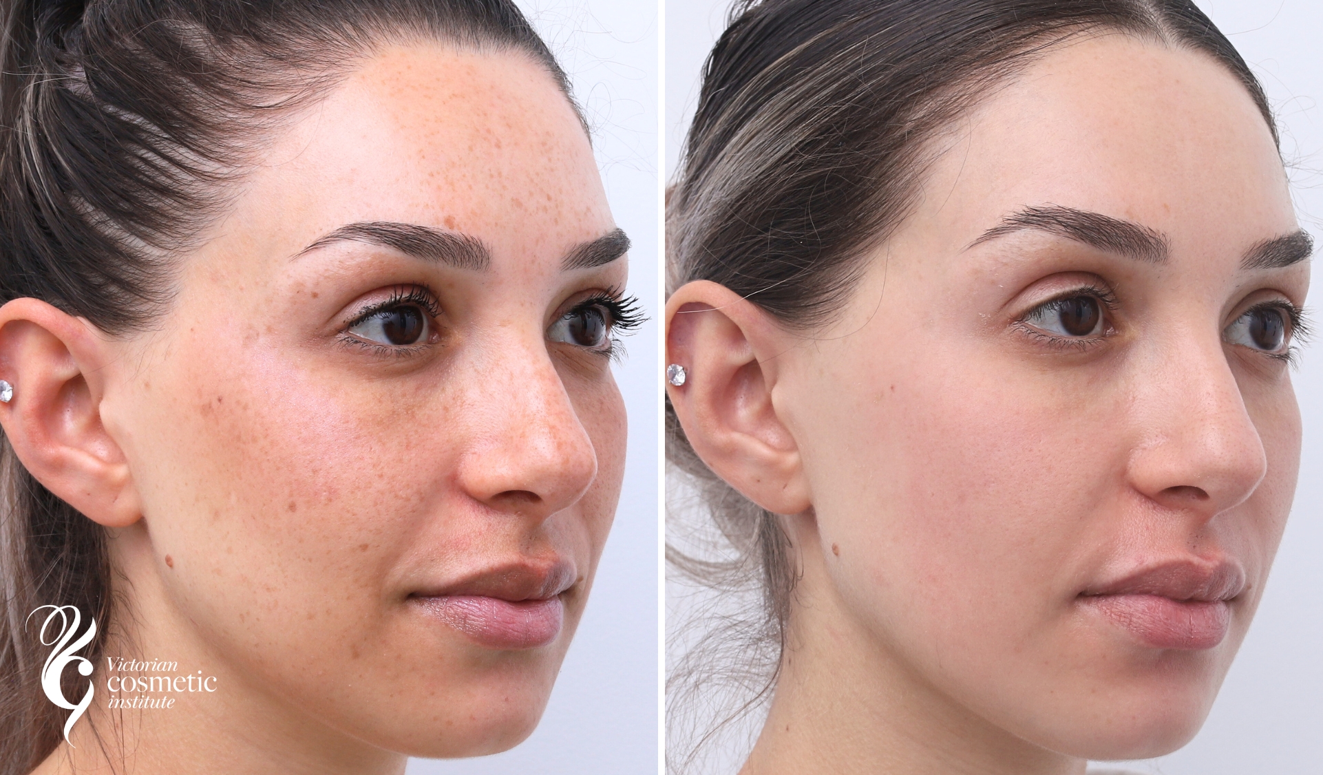 cosmelan peel for freckles