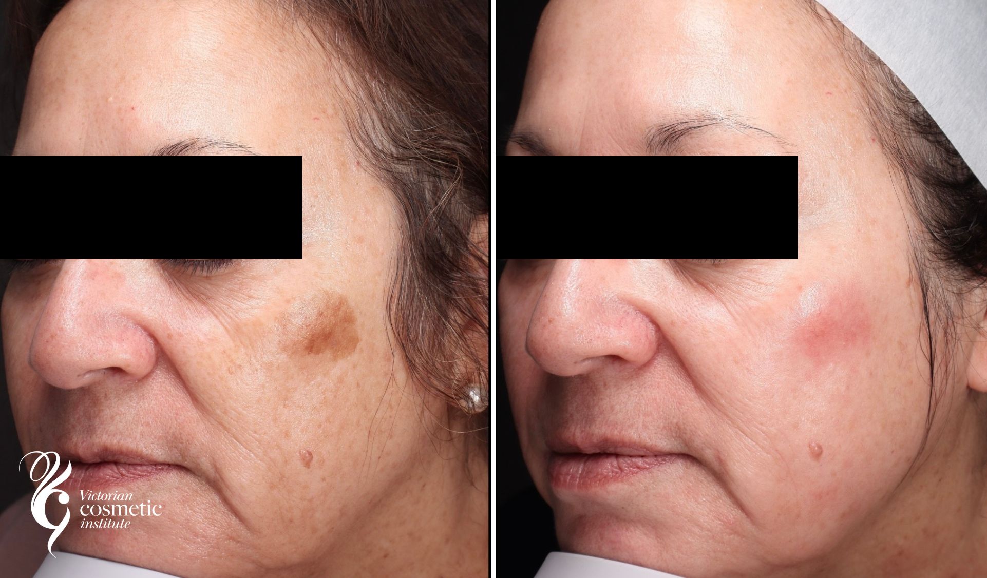 Cosmelan peel before and after pigmentation