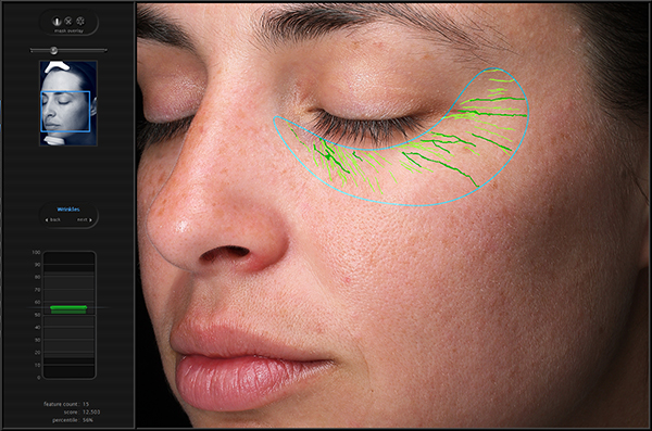 visia skin analysis wrinkles