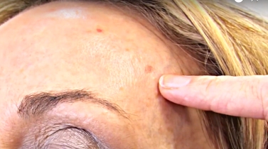 How to get rid of age spots