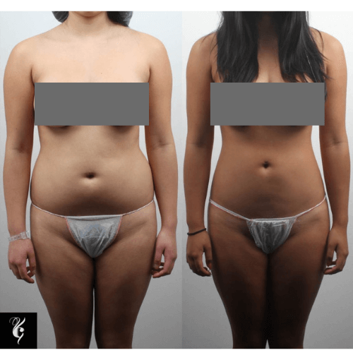Liposuction Melbourne