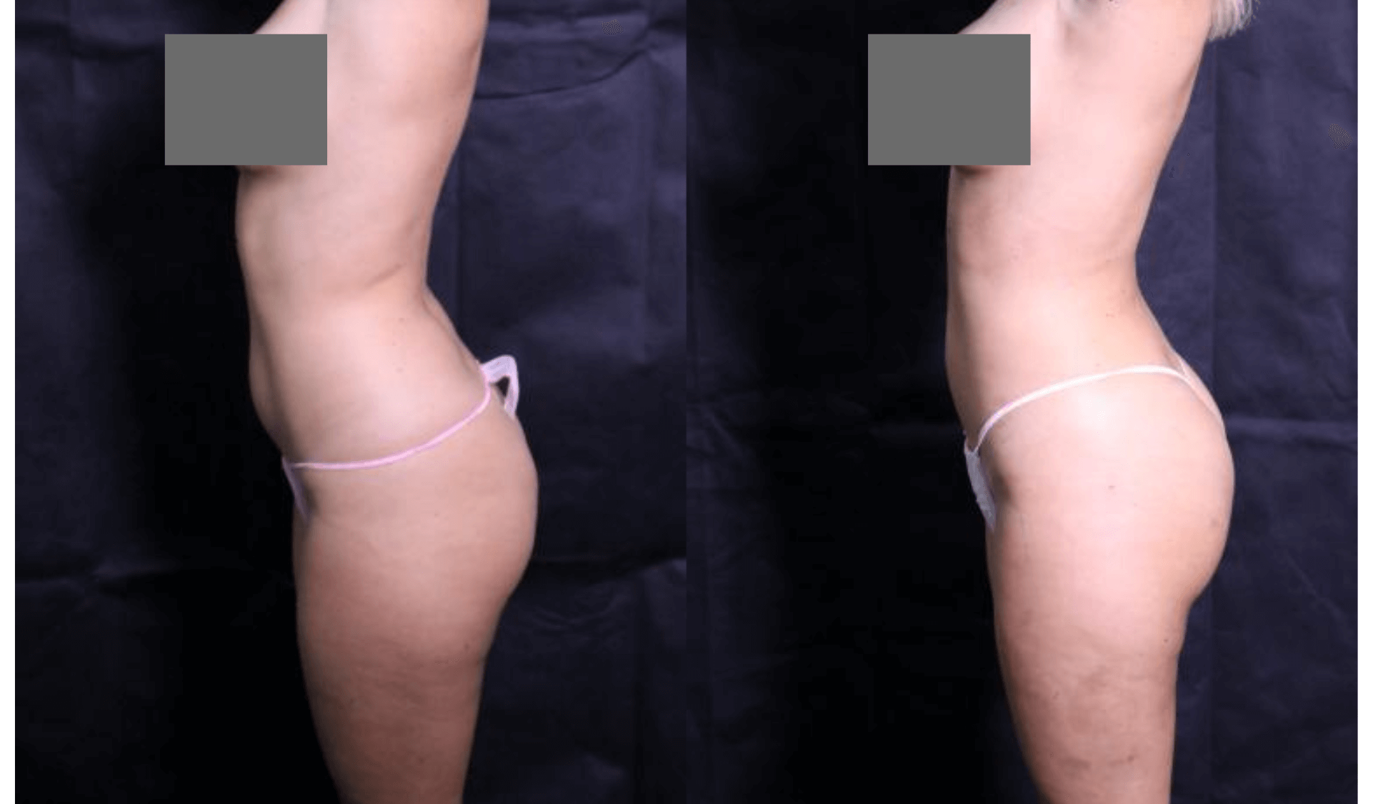 Liposuction side before and after