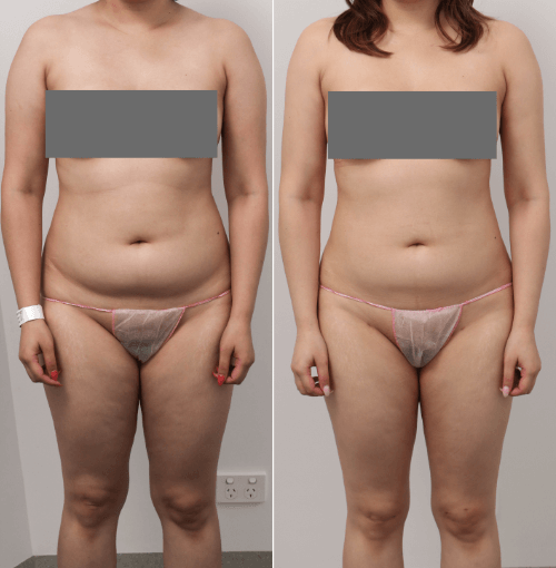 liposuction before and after