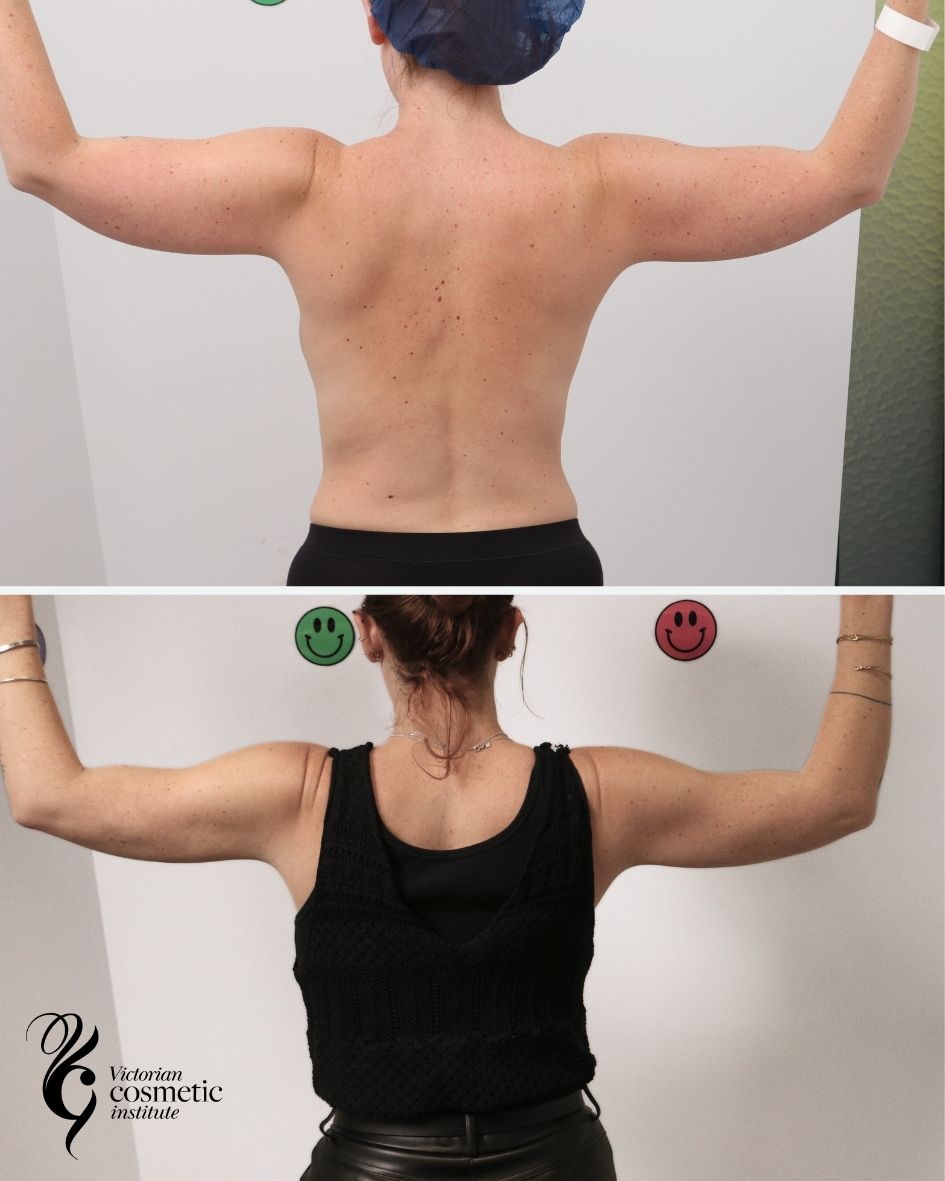 Before and after image of liposuction to arms