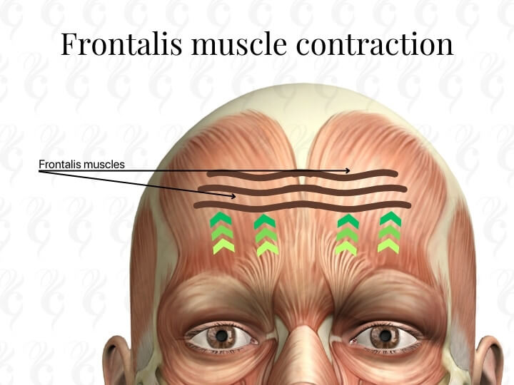 what causes wrinkle lines on forehead frontalis botox