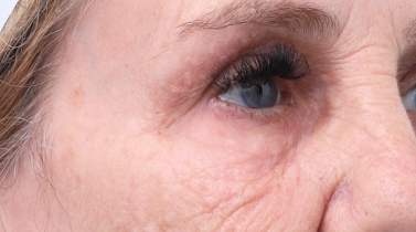 under eye skin booster melbourne blog