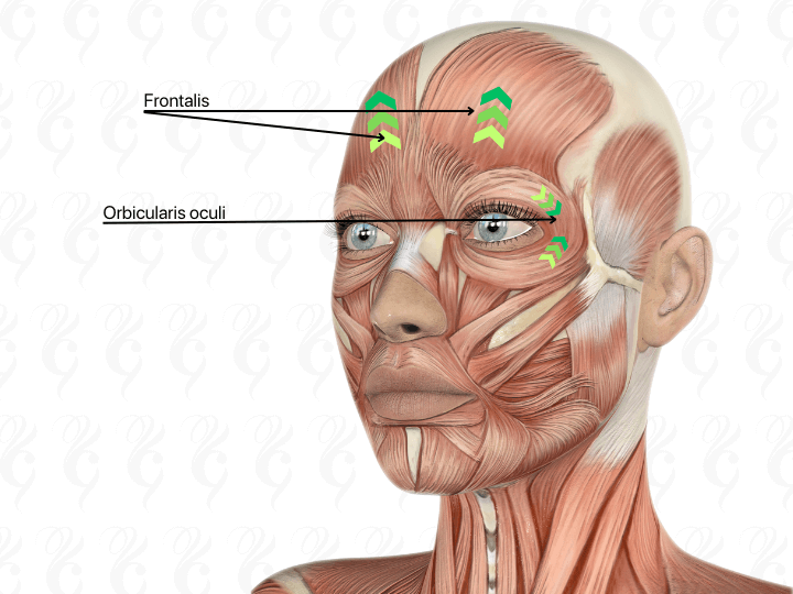 Frontalis and Orbicularis Oculi forehead botox treatment
