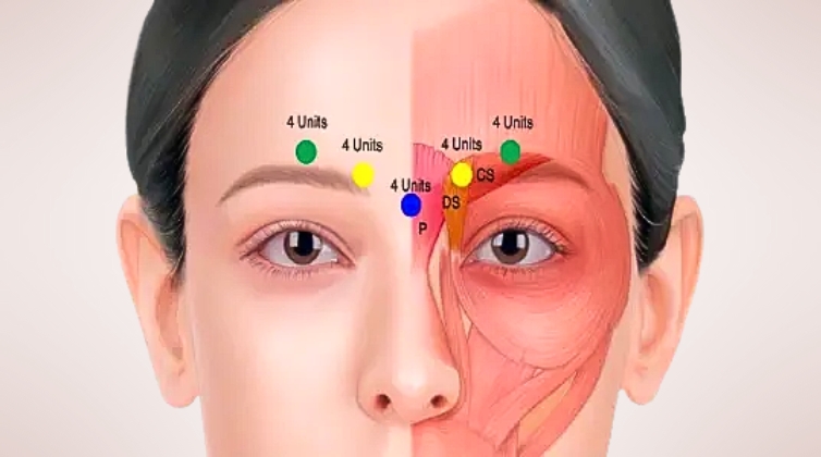 Why Are Frown Lines Traditionally Treated With Five Injection Points?